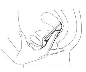 Inserting Diaphragm